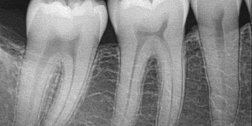 radiografie dentara